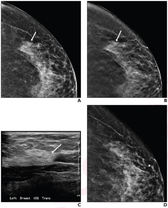 57-Year-Old Woman Presented for Screening Mammography