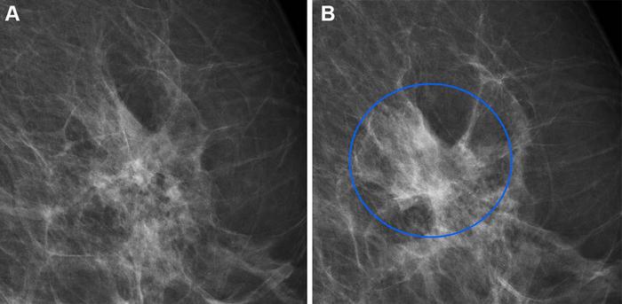 Full-field digital mammograms (left mediolateral oblique view)