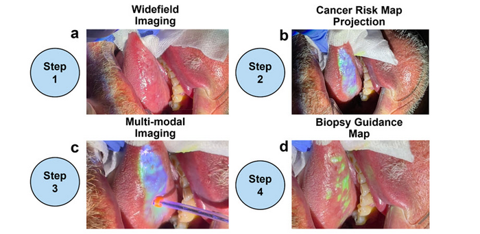 The active biopsy guidance system (ABGS) is a low-cost multi-imaging platform that helps clinicians identify suspicious looking lesions in the oral cavity in real time, facilitating the early detection of oral cancer.