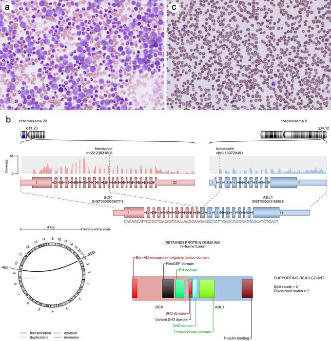 Chronic myeloid leukemia, Chronic phase and Philadelphia chromosome (BCR::ABL1 fusion gene)