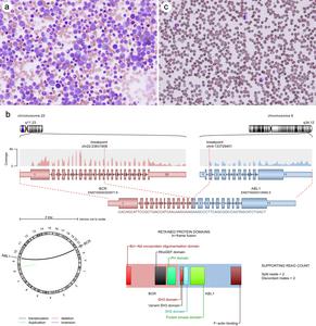 Chronic myeloid leukemia, Chronic phase and Philadelphia chromosome (BCR::ABL1 fusion gene)