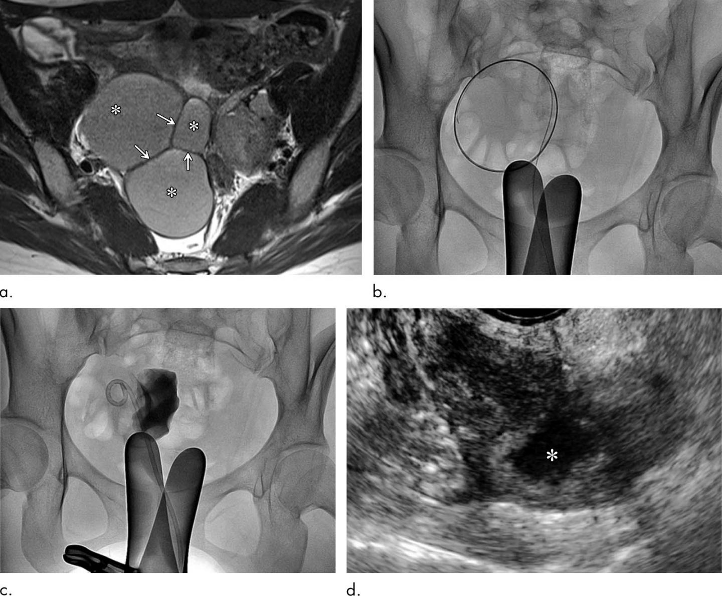 Clinical Course of a 27-Year-Old Woman with Primary Ovarian Endometrioma Presenting with Dysmenorrhe