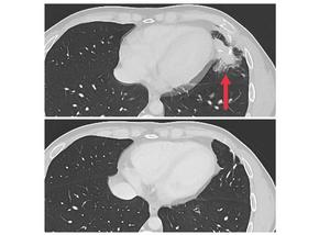 Cross-sectional CT images showing a metastatic tumor and no tumor following treatment