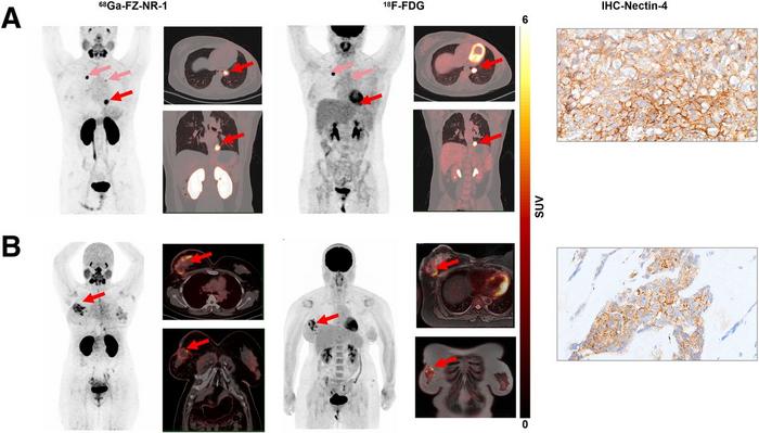 PET/CT and PET/MR images in representative Nectin-4–positive TNBC patients