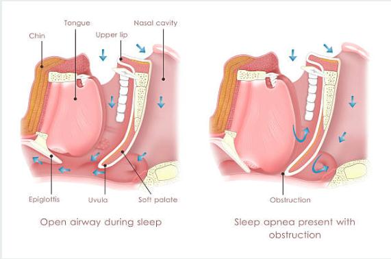Clear and Blocked Airway during Sleep