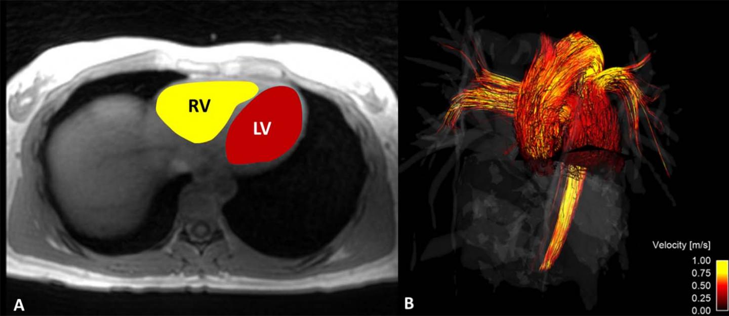 MRI Shows Blood Flow Differs in Men and Women (1 of 2)