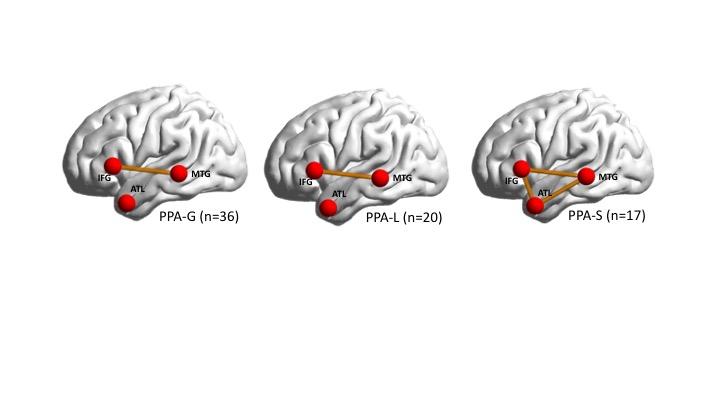 Impaired Brain Connection in Each PPA Subtype