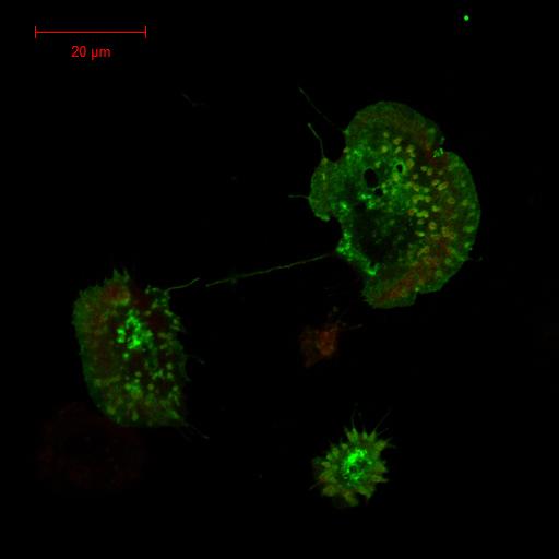 First Inherited Mutation in SRC Cancer Gene Identified in Humans (1 of 2)