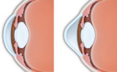 Normal and Keratoconus Corneas