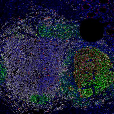 Chromosomal Clues to Cancer Survival (2 of 2)