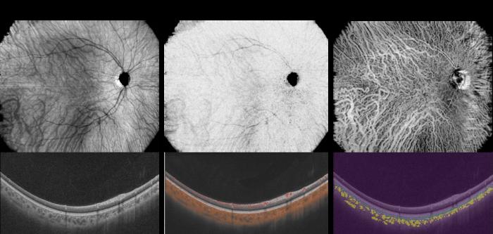 Newly developed mechanisms to visualize choroidal vessels