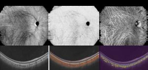 Newly developed mechanisms to visualize choroidal vessels