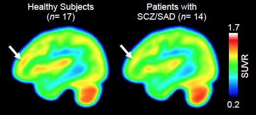 Altered Epigenetic Enzyme Expression in Schizophrenia