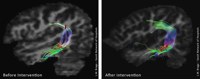: Study coordinated by Dr. Lucia W. Braga at the SARAH Network of Rehabilitation Hospitals shows neuroplasticity after intensive rehabilitation of massive stroke in the left hemisphere that severely impacted speech and language function