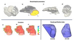 The role of the pulmonary veins on left atrial flow patterns and thrombus formation