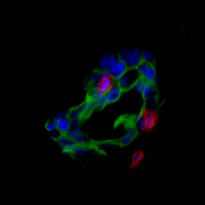 Ovarian Cancer Cells
