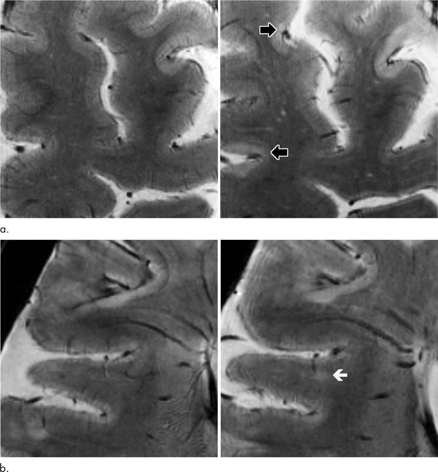 HighStrength MRI Tracks MS Pr [IMAGE] EurekAlert! Science News Releases