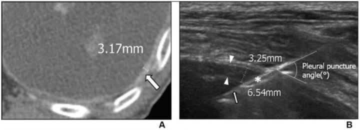 82-Year-Old Man Diagnosed With Tuberculous Pleurisy on US-Guided PCPNB