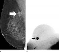 Mammogram (1 of 3)