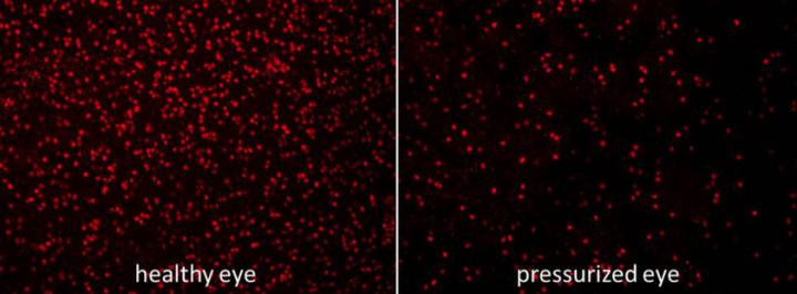 Eye Pressure Measurement