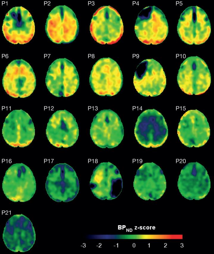 Brain Scan Images Showing Protein Tangles