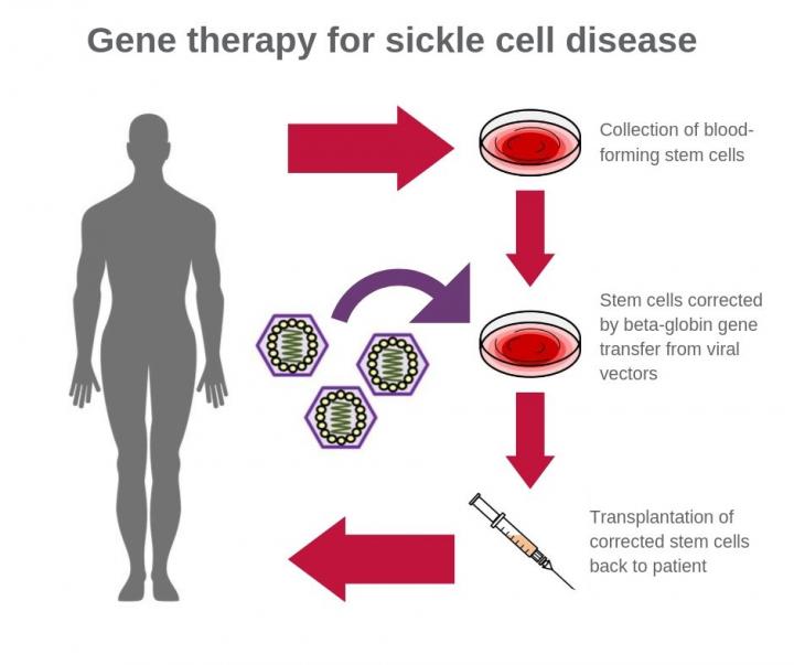 Gene Therapy for Sickle Cell Disease