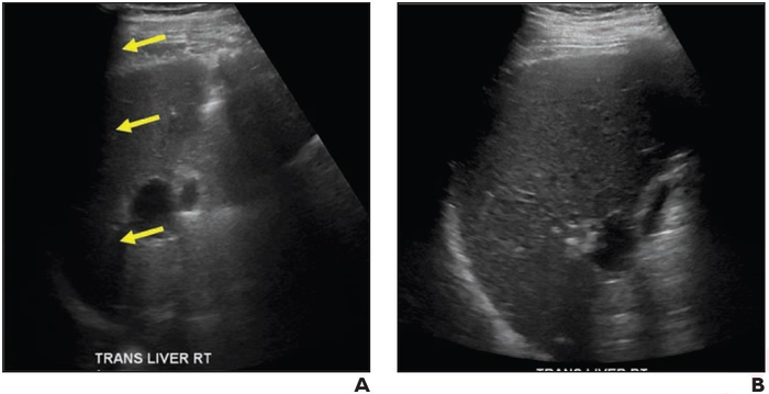 69-Year-Old Man With Chronic H [IMAGE] | EurekAlert! Science News Releases