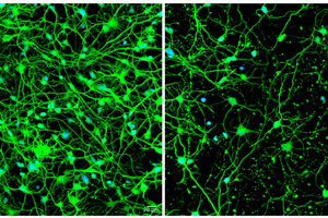 Cellular housekeeping process implicated in fatal neurological disorder