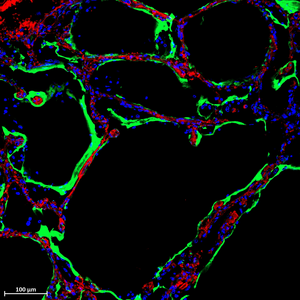 Green highlights protein receptor in lung tissue with COVID-19