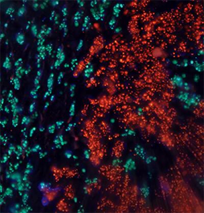 New models of drug-resistant breast cancer hint at better treatments