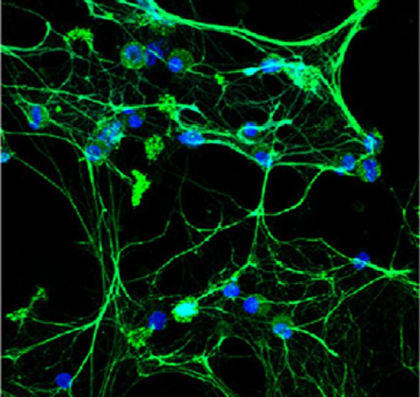 Lupus White Blood Cells Form D [IMAGE] EurekAlert! Science News Releases