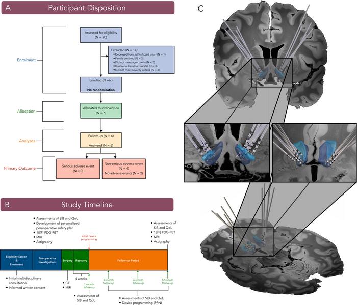 New Pilot Study Shows Deep Brain Stimulation May Reduce Severe Self-Injurious Behavior in Children with Autism Spectrum Disorder