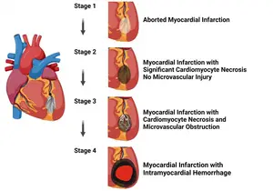 First Classification of Four Stages of Heart Attack Based on Heart Muscle Damage Is Released