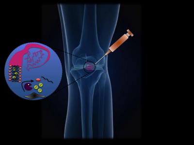 Novel Gel Could Treat Arthritis