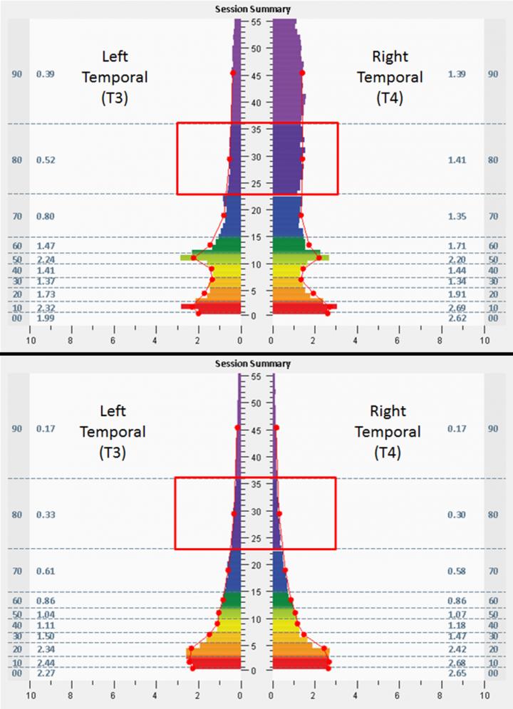 Athletes with Concussion Maintain Improvements after Use of Mirroring Neurotechnology