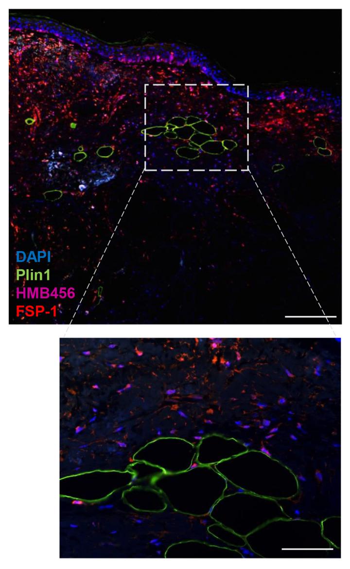 Fat Cells Trigger A Metastatic Switch In Mela Eurekalert