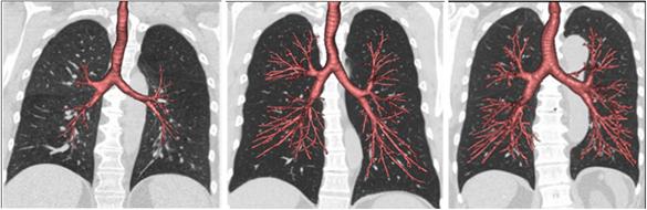 CT Scans of Airways