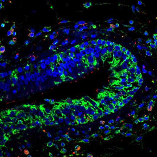 Immunohistochemical Staining of Nasal Polyp Tissue