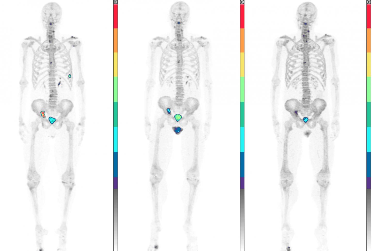 Improved Disease on NaF-PET/CT in a 66-Year-Old Male with mCRPC who Had a PSA response to Docetaxel 