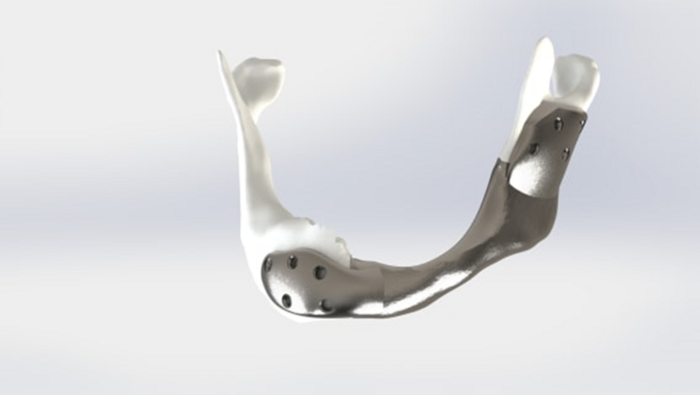 custom 3D-printed titanium lower jaw