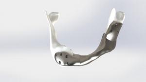 custom 3D-printed titanium lower jaw