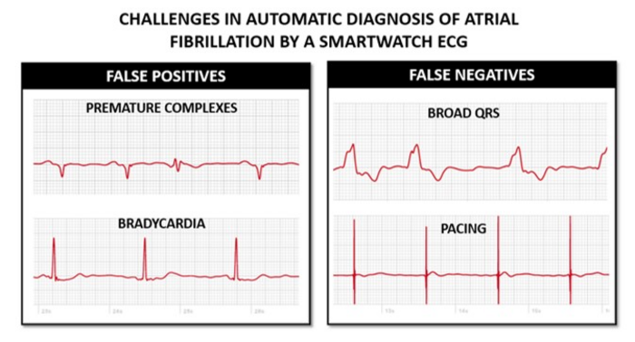 Challenges in Automatic Diagnosis of Atrial Fibrillation by a Smartwatch ECG