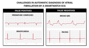 Apple watch ecg 2025 inconclusive over 100