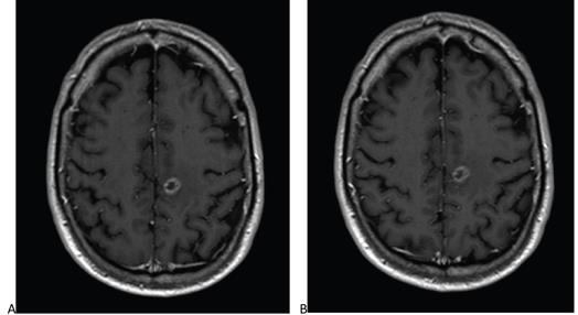 61-Year-Old Man With Left Hemispheric Brain Metastasis From Lung Cancer