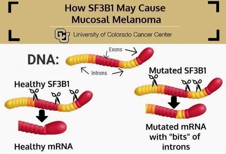 Mutated SF3B1 May Drive Mucosal Melanoma