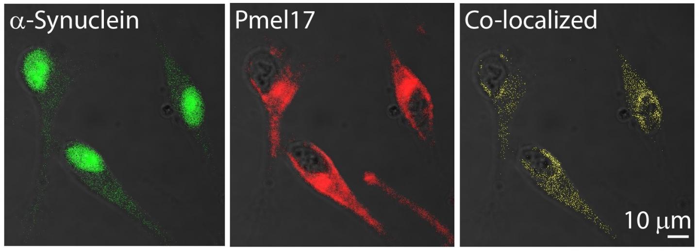 An Amyloid Link between Parkinson's Disease and Melanoma