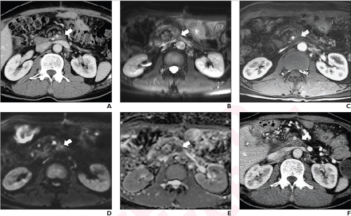 48-year-old man who underwent pylorus-preserving pancreatoduodectomy with superior mesenteric vein resection and reconstruction for pancreatic ductal adenocarcinoma (T3N1)