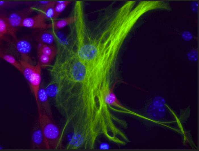 The melanoma-astrocytes interactions