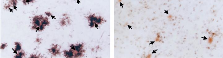 TREM2 Removal Halts Alzheimer's