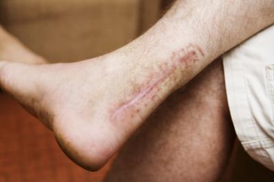 Serious Foot Injuries Can Stall or End Sports Careers